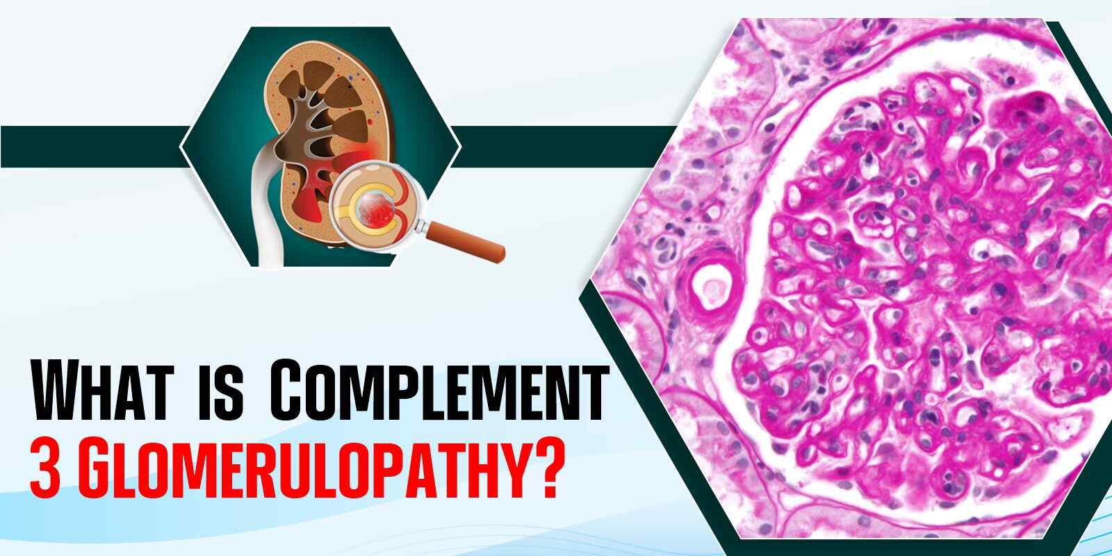 What is Complement 3 Glomerulopathy?